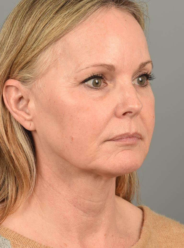 Facelift case #11457