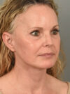 Facelift case #11457