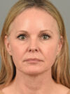 Facelift case #11457