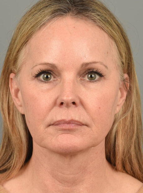 Facelift case #11457
