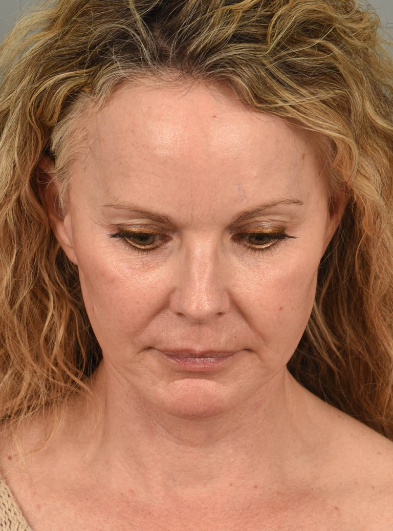 Facelift case #11457