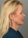 Facelift case #11560