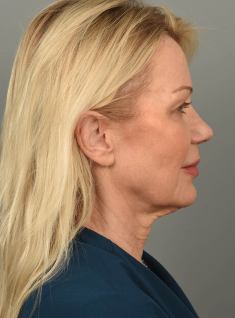 Facelift case #11560