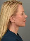 Facelift case #11560