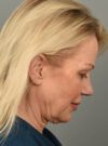 Facelift case #11560