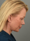 Facelift case #11560