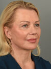 Facelift case #11560