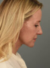 Facelift case #11553