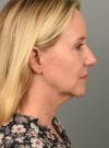 Facelift case #11553