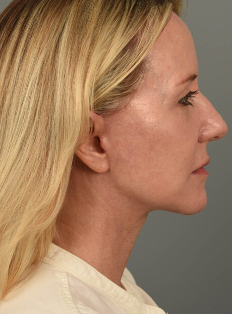 Facelift case #11553