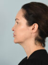 Facelift case #11495