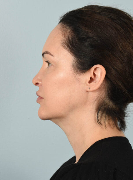 Facelift case #11495