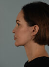 Facelift case #11495