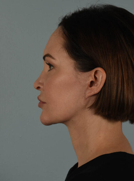 Facelift case #11495