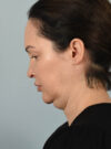 Facelift case #11495