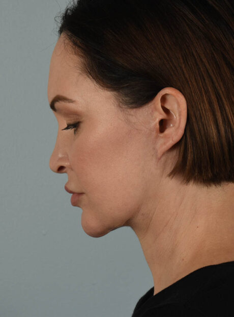 Facelift case #11495