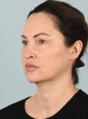Facelift case #11495