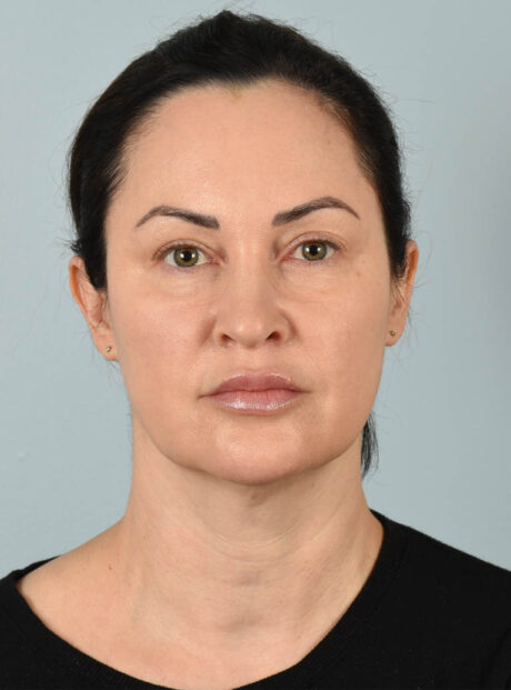 Facelift case #11495