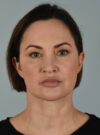 Facelift case #11495
