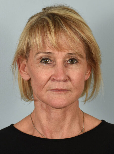 Facelift case #11386