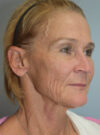 Facelift case #11386