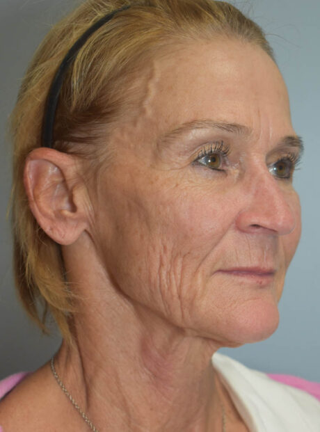 Facelift case #11386