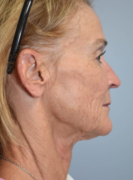Facelift case #11386