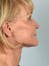 Facelift case #11386