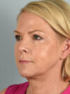 Eyelid Surgery case #11505