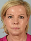 Eyelid Surgery case #11505