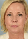 Eyelid Surgery case #11505