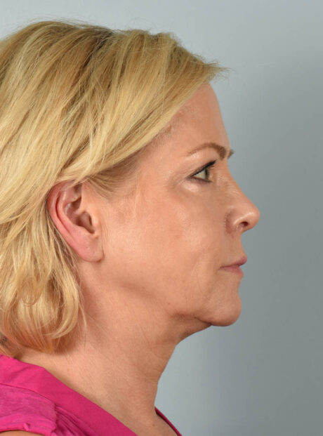 Eyelid Surgery case #11505