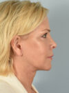 Eyelid Surgery case #11505