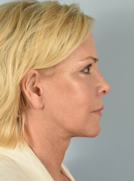 Eyelid Surgery case #11505
