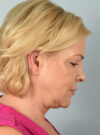 Eyelid Surgery case #11505