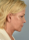 Eyelid Surgery case #11505