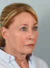 Facelift case #11523