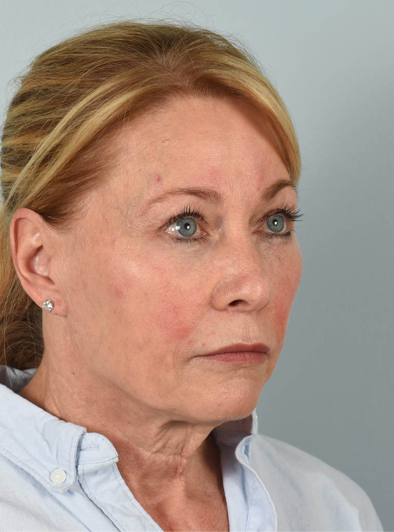 Facelift case #11523