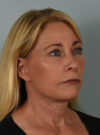 Facelift case #11523