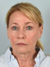 Facelift case #11523