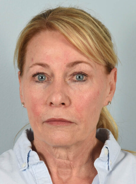 Facelift case #11523