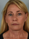 Facelift case #11523