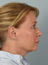 Facelift case #11523