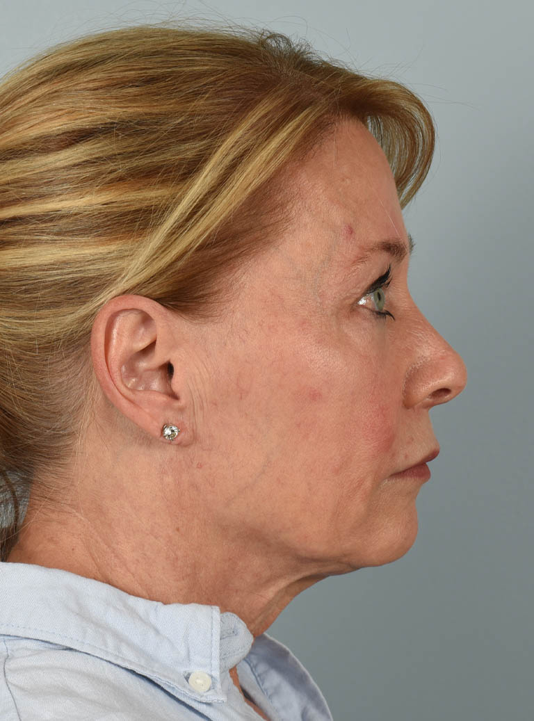 Facelift case #11523