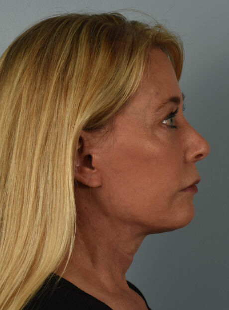 Facelift case #11523