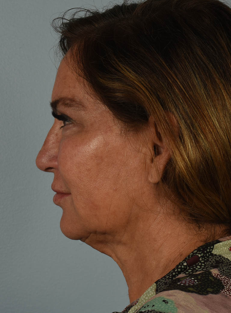 Facelift case #11477