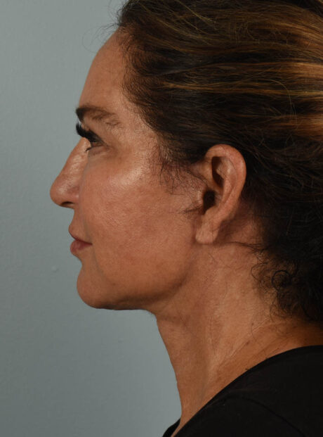 Facelift case #11477