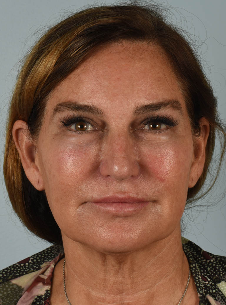 Facelift case #11477