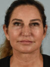 Facelift case #11477
