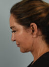 Facelift case #11477